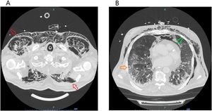 Thoracic CT scan (axial plane) revealing extensive subcutaneous cervical and thoracic emphysema (red arrows) with discernible muscular fibres dissection. Green arrow pointing to finding of predominant anterior pneumomediastinum. COVID pneumonia typical peripheral consolidation with ground-glass opacification (orange arrow).