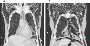 Thoracic CT scan (coronal plane) demonstrating extension of pneumomediastinum (orange arrows) and pneumoperitoneum (red arrows), with visible air space below diaphragm accentuating superior liver contour.