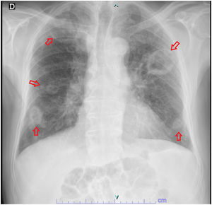Chest radiography after 10 days anti biotherapy, visible multiple nodular lesions bilaterally (red arrows), not present on admission.