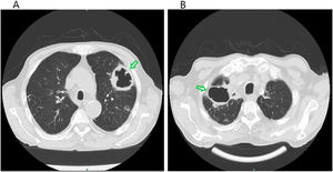Thoracic CT scan (axial) demonstrating the larger lesions visible on the chest radiography (green arrow), corresponding to cavitated abscess of 67mm in the right apical lobe and a 54mm diameter lesion localized in the posterior segment of the left superior lobe.