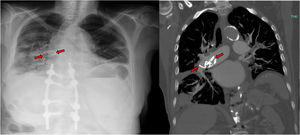 Radiografía simple de tórax en proyección PA. Se visualiza imagen radiopaca curvilínea proyectada sobre el hilio pulmonar derecho sugestiva de cuerpo extraño (flechas rojas). AngioTC torácico con reconstrucción MIP en plano coronal. Se identifica material hiperdenso de morfología serpinginosa en el interior de la arteria pulmonar principal derecha que se corresponde con la imagen visualizada en la radiografía, en relación a migración de cemento óseo (flechas rojas).