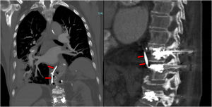 AngioTC torácico con reconstrucciones MIP en planos coronal y sagital. Se observa material hiperdenso curvilíneo procedente de artrodesis previa, que se correspondería con migración de cemento óseo hacia el sistema hemiácigos (flechas rojas).