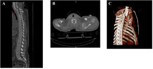 Displacement/anterolisthesis of the vertebral body from C6 in relation to C7.