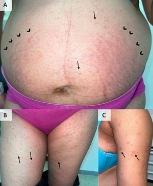 Presentation of skin lesions at the time of consultation. They were erythematous and shiny papules (black arrows) of abdominal distribution (panel a), lower limb root (panel b) and upper limb root (panel c). As can be seen in panel a, the respect of the periumbilical area and the predominant involvement of the abdominal distension striae (arrowheads in panel a) were notorious.