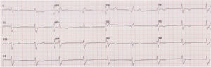 ECG basal.