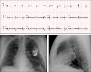 Panel superior: ECG postimplante de electrodo de estimulación en área de rama izquierda de haz de His. Es destacable la reducción de la anchura de QRS hasta 136 ms, la presencia de r´en V1 y un tiempo de activación ventricular en V6 de 62 ms que indican captura de la rama izquierda. Panel inferior: radiografía de torax en posición anteroposterior y lateral donde se observa el electrodo del marcapasos en la región del septo ventricular.