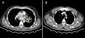 Tomografía computarizada toracoabdominal A) 2 tumoraciones parahiliares izquierdas sospechosas y B) adenomegalias mediastínicas y axilares.