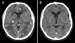 Mejoría radiológica a las 3 semanas de tratamiento.