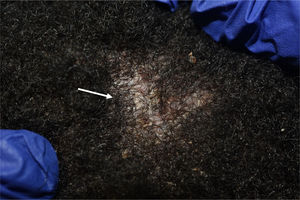 Occipital 2*2 cm plaque with crusts on its surface. Decreased hair density, without clear scarring alopecia.