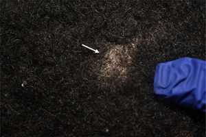 1.5*2 cm alopecia plaque in the right parietal region.