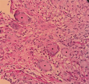 Several Langhas cells marked with stars.