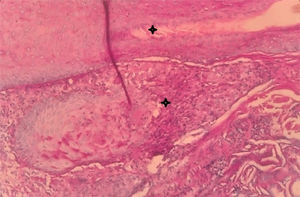 The upper star indicates a hair follicle and the lower one a sarcoid type Langhas cell.