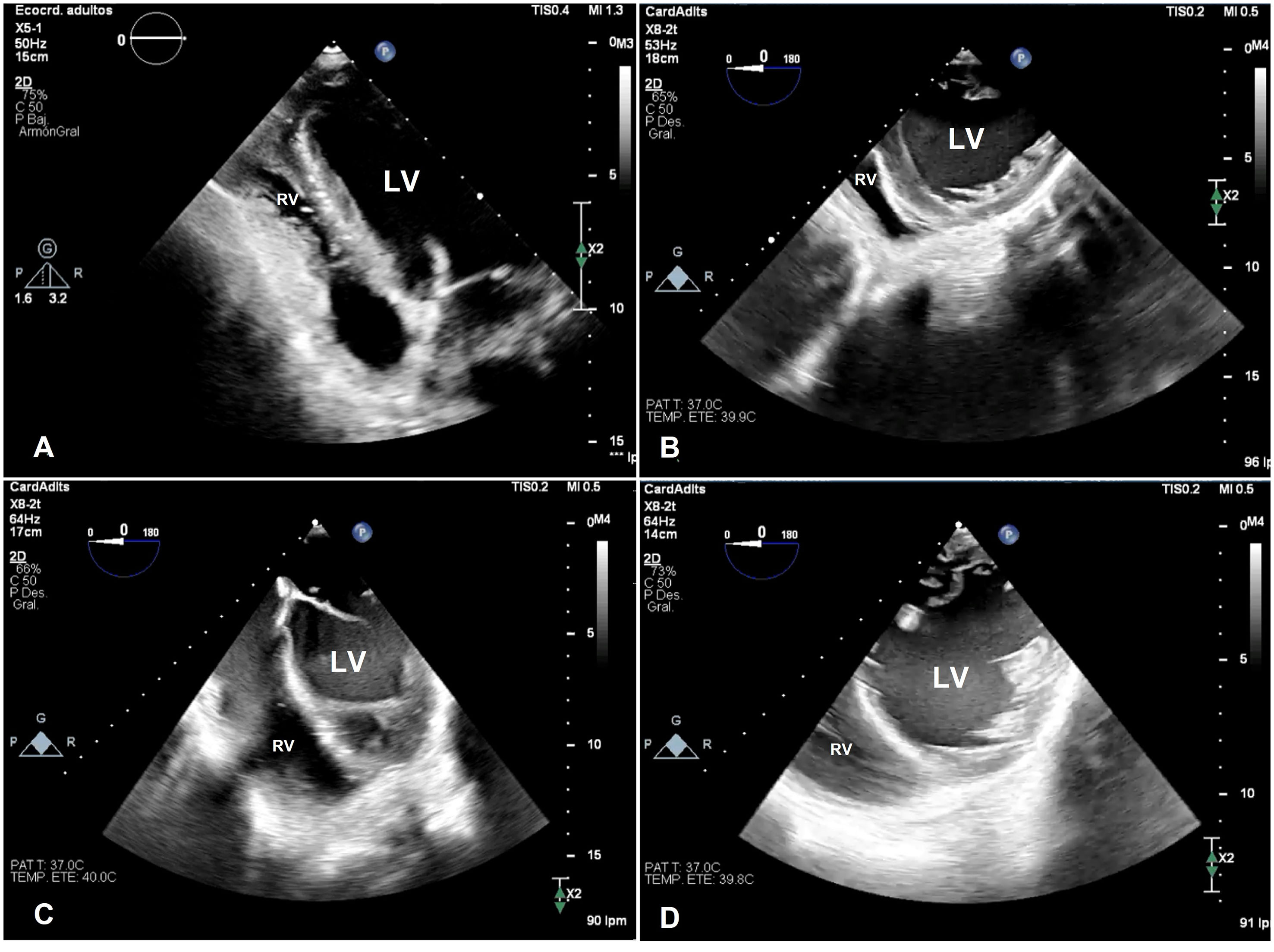 Echocardiographic findings in tension pneumothorax | Medicina Clínica ...