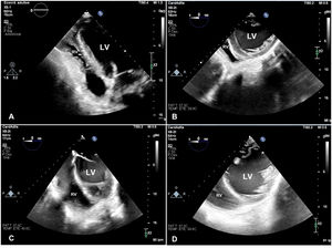 A: Transthoracic echocardiography. Apical four-chamber view showing severe collapse of the right ventricular free wall and displacement of the heart to the left. B: Transesophageal echocardiography (TEE). Deep transgastric view showing tethering of the right ventricular free wall and diastolic flattening of left ventricular anterior free wall. C: ETE. Mid-esophageal four-chamber view showing resolution of the right ventricular collapse and normal position of the heart at the center of the thorax. D: TEE. Deep transgastric view showing resolution of the tethering of the right ventricular free wall and diastolic flattening of left ventricular anterior free wall. RV: Right ventricle, LV: left ventricle.