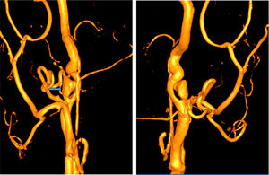 En la reconstrucción del angio-TC se aprecia en el eje carotídeo derecho una imagen de seudoaneurisma sugerente de disección crónica.