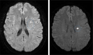 RMN cerebral donde se aprecian milimétricos focos de restricción, en relación con lesiones isquémicas agudas/subagudas en territorio de arteria cerebral media y cerebral anterior izquierdas.