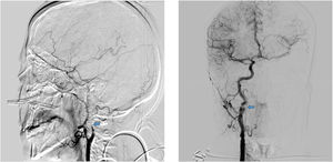 Imágenes de arteriografía por sustracción digital en las que se observa en la imagen de la izquierda una oclusión de la ACI izquierda posbulbar con afilamiento del calibre y posterior oclusión (signo de la llama) sugestiva de disección aguda. En la imagen de la derecha, se constata ateromatosis carotídea con una imagen de seudoaneurisma sugestivo de disección crónica.