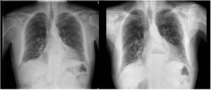 A la izquierda: radiografía PA tórax (2018). Infiltrado intersticial bilateral de predominio periférico y en bases. A la derecha: radiografía PA tórax (2021). Se aprecia progresión del patrón intersticial retículo nodular con gradiente ápico-basal.
