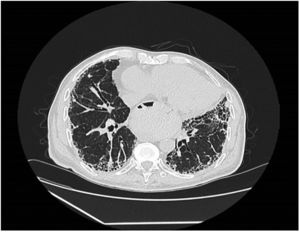 TAC tórax (ventana pulmonar). Distorsión arquitectural con fibrosis intersticial reticular de predominio subpleural difuso. Se aprecian bronquiectasias y bronquiolectasias por tracción, de predominio en campos basales.