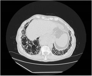 TAC tórax (ventana pulmonar). Extensas áreas de panalización con gradiente ápico-basal.