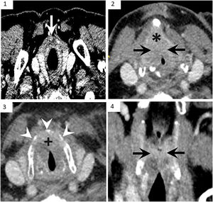 Tomografía computarizada con contraste. Cortes transversales (1,2,3) y coronal (4). Masa afectando a las 2 cuerdas vocales con extensión a través de comisura anterior (+). Infiltración de grasa preepiglótica (*), grasa paraglótica bilateral (flechas negras) y cartílago tiroides (puntas de flecha blancas). En la imagen 1 se observa una adenopatía delfiana en estación VI (flecha blanca).