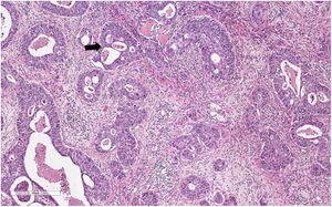 Componente adenocarcinomatoso del LASC, tinción hematoxilina-eosina. Se aprecian proliferación de luces glandulares con necrosis central (flecha negra) y estructuras cribiformes. Este componente predominaba en la parte profunda de la tumoración.