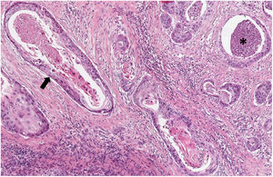 Componente escamoso del LASC, tinción hematoxilina-eosina. Se aprecian nidos de carcinoma escamoso con queratinización central (flecha negra). En la parte superior derecha se identifican algunas glándulas con necrosis central (*). Las áreas de carcinoma escamoso predominaban en la parte superficial de la tumoración.