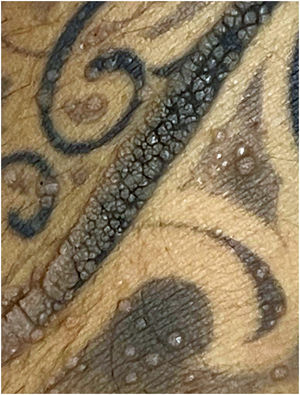 Several vulgar warts mainly confined to areas of tattoo pigment