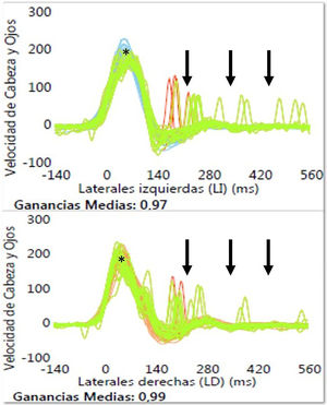 Registro video Head Impulse Test (vHIT) de ambos canales semicirculares laterales durante el primer día de ingreso. Clínicamente la paciente presentaba un síndrome vestibular agudo aislado. Los resultados demuestran bilateralmente la presencia de ganancias medias normales del reflejo vestíbulo-ocular (0,97 en lado izquierdo y 0,99 en lado derecho, (*) así como la ausencia de sacadas de refijación (flechas negras).