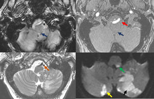 A) Estudio de resonancia magnética de cortes axiales. Técnica empleada, de izquierda a derecha y de superior a inferior: GRE, ARM TOF 3D, T2 FSE y DWI (b-valor 1.000). Hallazgos: infarto agudo con restricción de difusión en los territorios distales de la arteria cerebelosa posteroinferior (PICA) izquierda (flecha negra: hemisferio cerebeloso basal izquierdo y vermis ipsilateral inferior) y de ramas perforantes medulares (flecha verde: bulbo posterolateral). Foco isquémico agudo cerebeloso basal contralateral (flecha amarilla). Se muestra la ausencia de flujo por trombosis en el segmento V4 de la arteria vertebral izquierda (flecha roja) y PICA izquierda (flecha azul: se señalan sus segmentos: medular, posterior y supratonsilar). Nótese la diferencia de señal respecto a segmento V4 derecho en eco de gradiente y en 3D TOF. En T2 falsa imagen de luz permeable (flecha naranja: hiposeñal en la arteria durante T2, debido al carácter agudo del trombo). B) Reconstrucción MIP de estudio RM 3D T1 + RM con gadolinio de TSA (lados derecho e izquierdo). Hallazgos: disección de la arteria vertebral izquierda en el segmento V2. Izquierda: angiografía por RM (ARM) muestra afilamiento oclusivo en segmento V2 de la arteria vertebral izquierda, característico de DAV (flecha naranja). La arteria vertebral derecha es permeable (flecha azul). Derecha superior: RM Axial T1 FS muestra hiperseñal periférica en la pared vascular de AV izquierda nivel V2-V3 representando un hematoma intramural (flecha amarilla). Derecha inferior: RM Axial T2 muestra ausencia de vacío de señal en AV izquierda nivel V2-V3 (flecha roja), la derecha sí muestra el vacío de señal normal (flecha verde).
