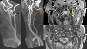 A) Estudio de resonancia magnética de cortes axiales. Técnica empleada, de izquierda a derecha y de superior a inferior: GRE, ARM TOF 3D, T2 FSE y DWI (b-valor 1.000). Hallazgos: infarto agudo con restricción de difusión en los territorios distales de la arteria cerebelosa posteroinferior (PICA) izquierda (flecha negra: hemisferio cerebeloso basal izquierdo y vermis ipsilateral inferior) y de ramas perforantes medulares (flecha verde: bulbo posterolateral). Foco isquémico agudo cerebeloso basal contralateral (flecha amarilla). Se muestra la ausencia de flujo por trombosis en el segmento V4 de la arteria vertebral izquierda (flecha roja) y PICA izquierda (flecha azul: se señalan sus segmentos: medular, posterior y supratonsilar). Nótese la diferencia de señal respecto a segmento V4 derecho en eco de gradiente y en 3D TOF. En T2 falsa imagen de luz permeable (flecha naranja: hiposeñal en la arteria durante T2, debido al carácter agudo del trombo). B) Reconstrucción MIP de estudio RM 3D T1 + RM con gadolinio de TSA (lados derecho e izquierdo). Hallazgos: disección de la arteria vertebral izquierda en el segmento V2. Izquierda: angiografía por RM (ARM) muestra afilamiento oclusivo en segmento V2 de la arteria vertebral izquierda, característico de DAV (flecha naranja). La arteria vertebral derecha es permeable (flecha azul). Derecha superior: RM Axial T1 FS muestra hiperseñal periférica en la pared vascular de AV izquierda nivel V2-V3 representando un hematoma intramural (flecha amarilla). Derecha inferior: RM Axial T2 muestra ausencia de vacío de señal en AV izquierda nivel V2-V3 (flecha roja), la derecha sí muestra el vacío de señal normal (flecha verde).