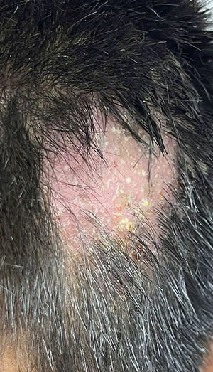 Alopecic patches with multiple crusts and pustules on the scalp.