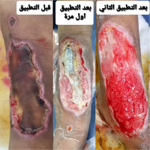 The leg of the 10-year-old child before, during, and after the treatment by zinc paste.