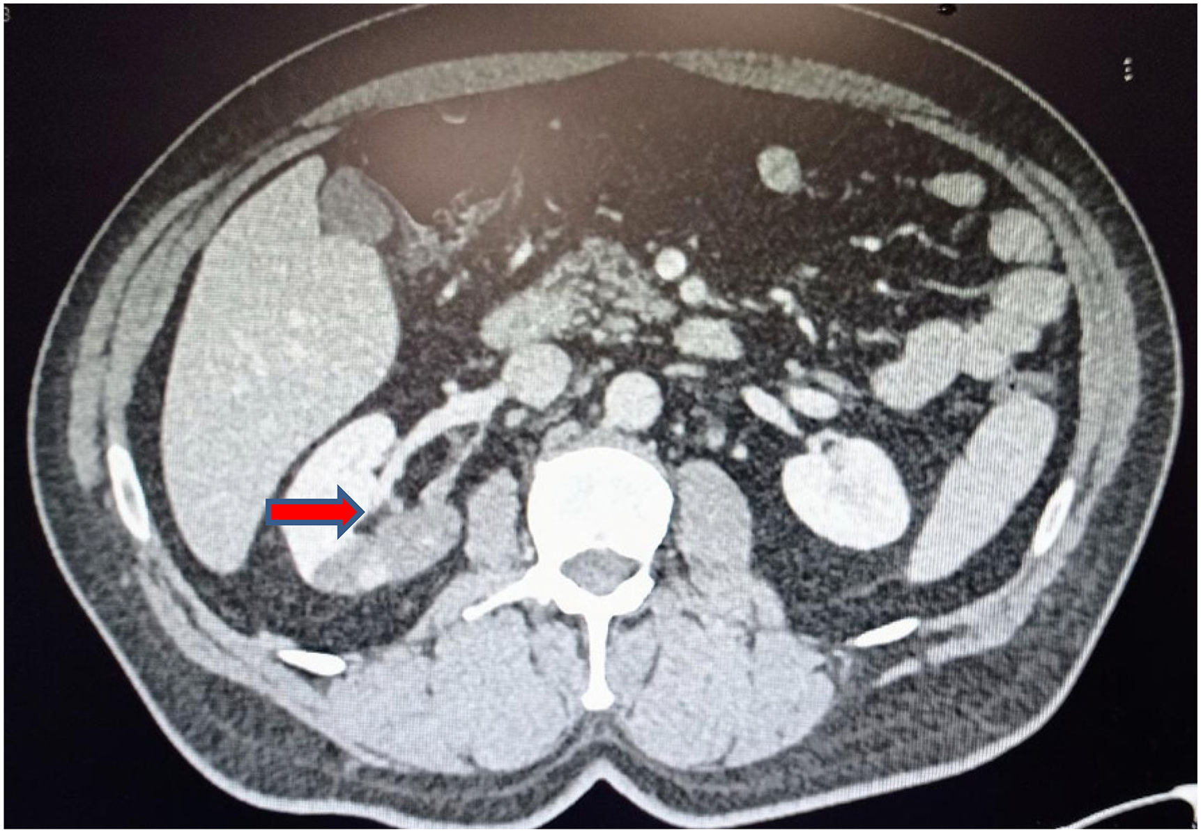Dolor abdominal por trombosis de la arteria renal | Medicina Clínica ...
