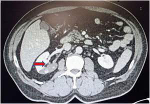 Imagen de la trombosis de la arteria renal derecha.