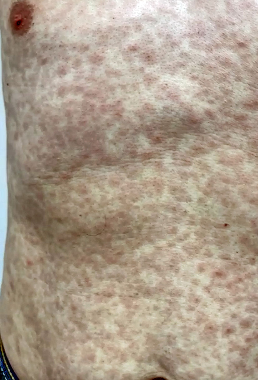 Syphilis Rash Trunk Secondary syphilis | Medicina Clínica Práctica
