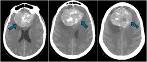 Meningioma in brain CT scan.