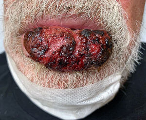 General appearance of the lower lip tumor.