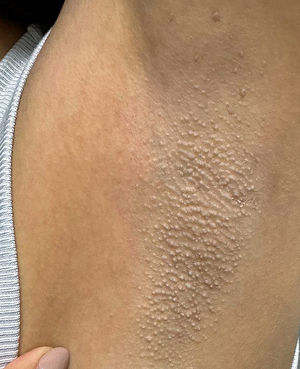 General appearance of the follicular papules on the skin of the left axillary region.