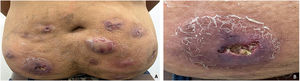 Abdomen with nodules, fistulae, and abscessed ulcerated lesions (A). An abscessed ulcer (B).