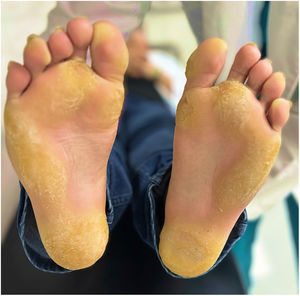 General appearance of compact plantar keratoderm on both feet.