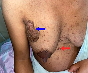 Puérpera con lesiones típicas de neurofibromas cutáneos y plexiformes.