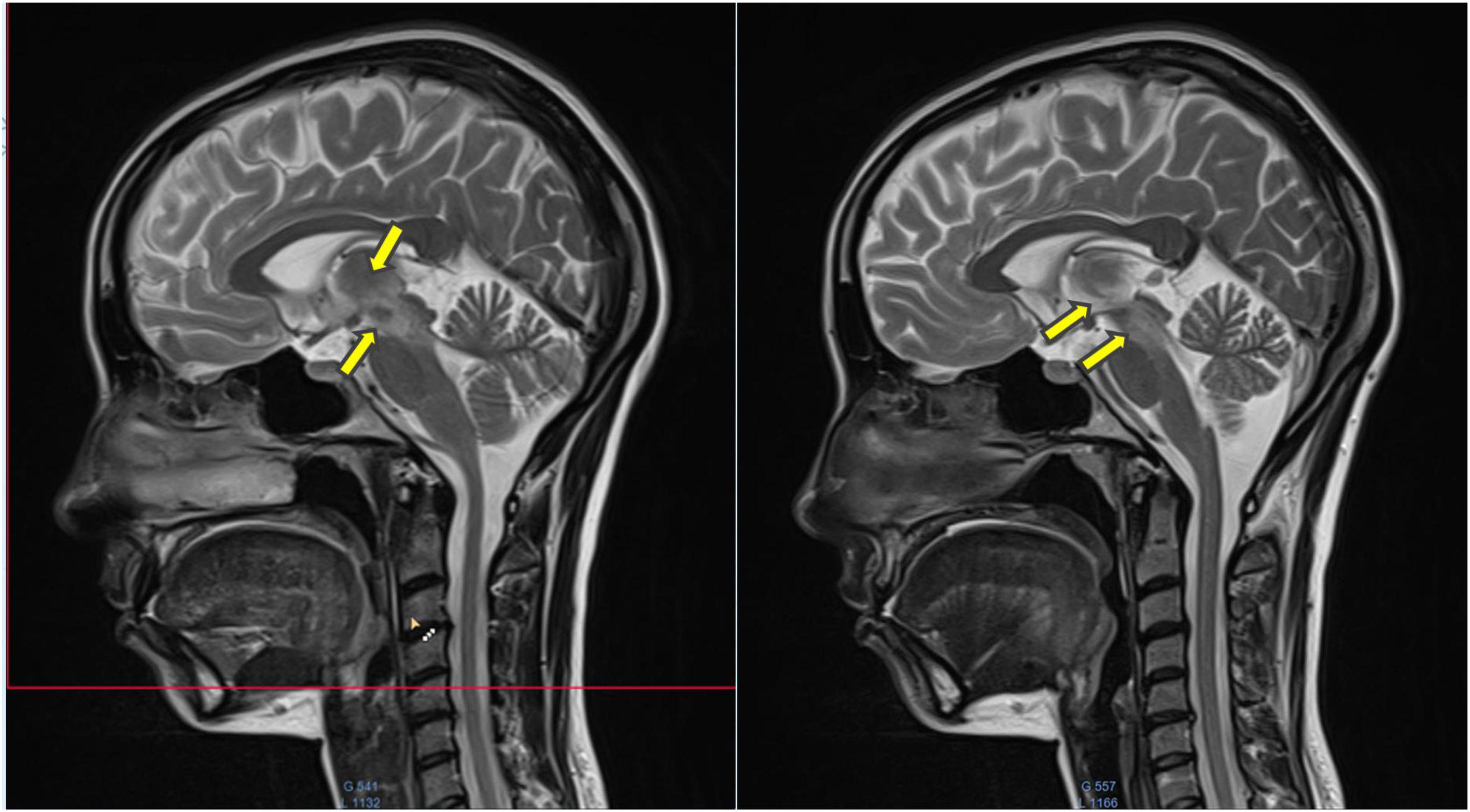 ‘Cascade Sign’ revealing a Behçet's disease | Medicina Clínica Práctica