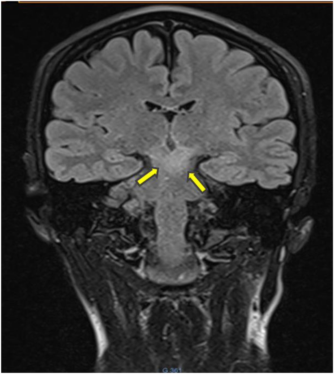 ‘Cascade Sign’ revealing a Behçet's disease | Medicina Clínica Práctica