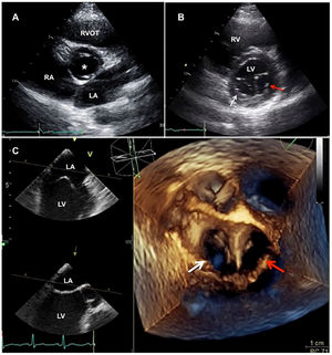 Transthoracic echocardiogram. A. Paraesternal short axis view at the great vessels in diastole. Bicuspid aortic valve with fusion of the right and left coronary cusps (white asterisk). B. Paraesternal short axis mitral view. Two separate mitral valve orifices were visualized; right (white arrow) and left orifice (red arrow). C. 3D transesophageal echocardiogram (multiplanar reconstruction); right (white arrow) and left orifice (red arrow). Two mitral orifices of equal size are shown. LA: left atrium, LV: left ventricle, RA: right atrium, RV: right ventricle, RVOT: right ventricular outflow tract. (For interpretation of the references to color in this figure legend, the reader is referred to the web version of this article.)