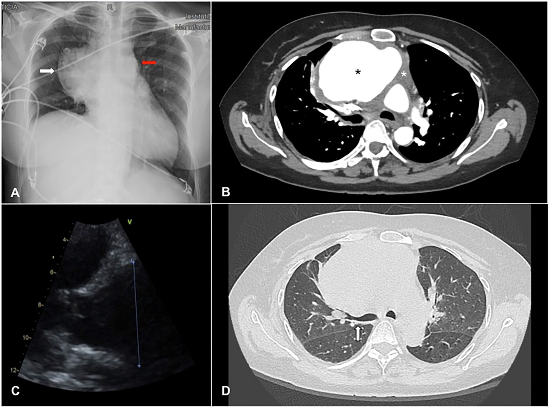 Aneurisma de aorta torácica ascendente simulando un tumor hiliar ...