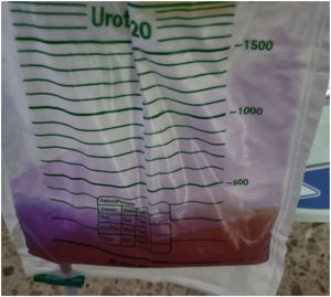 Sonda vesical. Orina de coloración violácea, 250 ml.