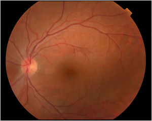 a) Fondo de ojo al inicio del episodio. Las flechas señalan placa amarillenta con afectación macular del ojo izquierdo. b) Fondo de ojo tras resolución del episodio a las 4 semanas.