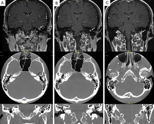 RM secuencia T1 con gadolinio, plano coronal (fila superior), y TC en plano axial (fila media) y coronal (fila inferior). Se demuestra la presencia de una lesión (flecha) fusiforme que depende del nervio facial y presenta un carácter expansivo, esta es isointensa en la RM bajo secuencia T1. La lesión se extiende desde el ganglio geniculado A), afectando a la segunda porción del nervio facial, B) así como a la tercera porción extendiéndose a través del agujero estilo-mastoideo. C) No hay afectación a nivel del ángulo pontocerebeloso o del canal auditivo interno. El hallazgo es compatible con un schwannoma del nervio facial.