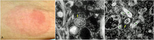 (A) General appearance of the lesion. (B) Transmission electron micrograph of the cytoplasm of a macrophage in the papillary dermis, where the cross section of a Borrelia flagellum is observed (yellow arrow, 50 000×). (C) Transmission electron micrograph of a culture of Borrelia burgdorferi, where we observed the ultrastructural characteristics of the cross-section of flagella of these bacteria, including a typical microtubular arrangement surrounded by a membrane (yellow arrow) and the longitudinal sections of those flagella (green asterisks, 20 000×). (For interpretation of the references to color in this figure legend, the reader is referred to the web version of this article.)